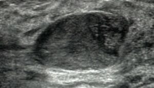 Fibroadenoma in ultrasound Heinohans Fibroadenoma of breast